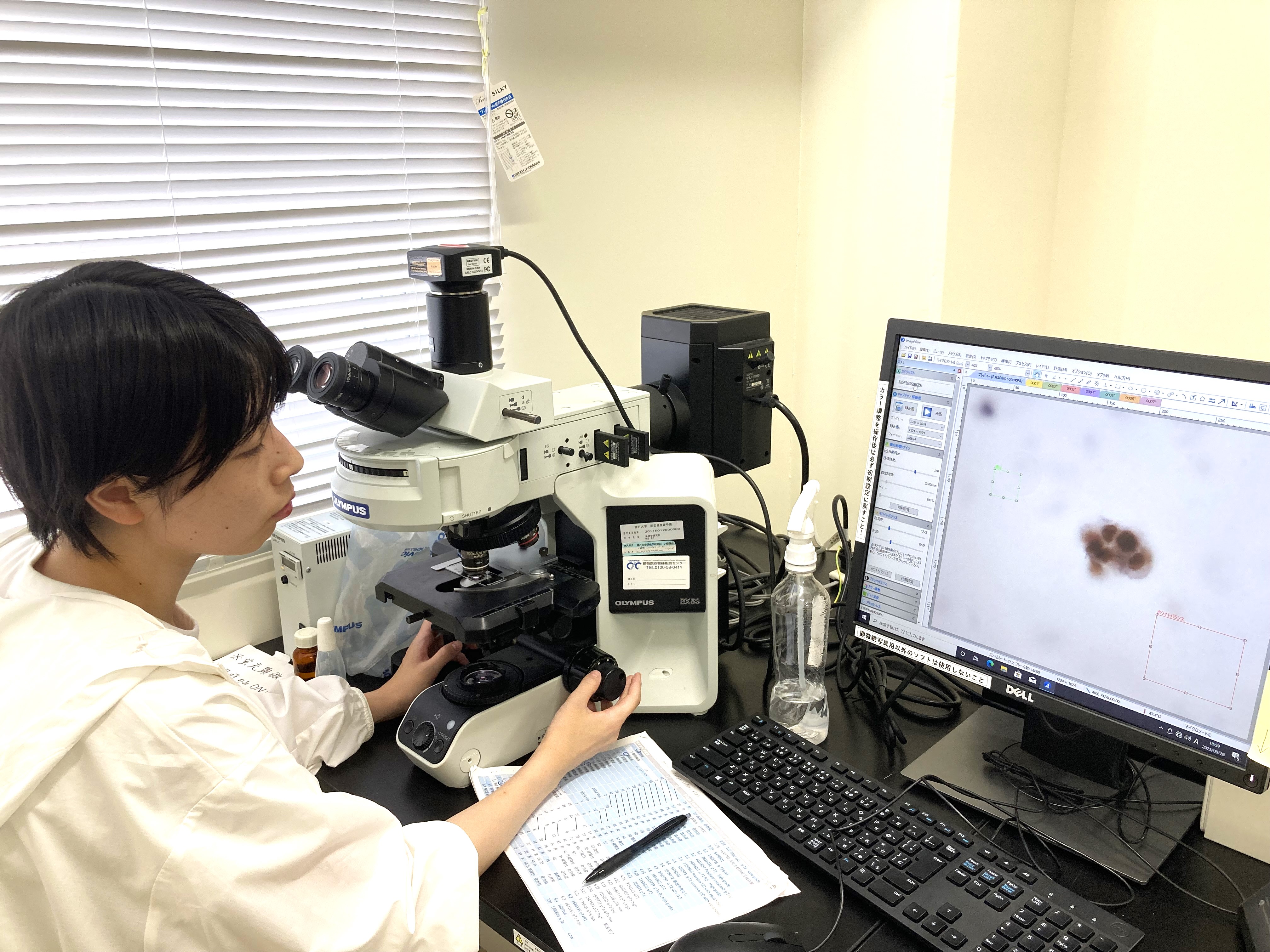 特殊な染色(免疫細胞化学)を行った尿中の癌細胞の顕微鏡写真を撮っています。